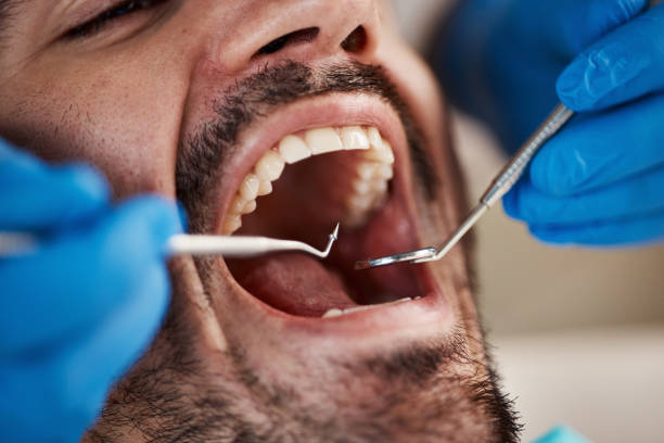Best Broken or Cracked Tooth Emergency Dentist in Wabash, IN