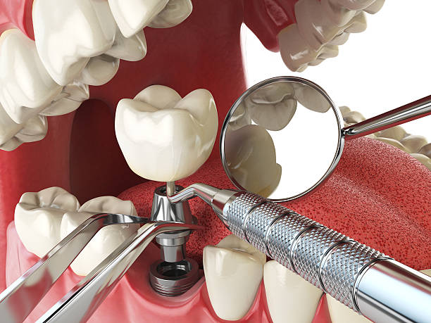 Best Emergency Dentist for Knocked-Out Tooth in Wabash, IN